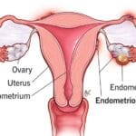 10857 endometriosis e1729445626810
