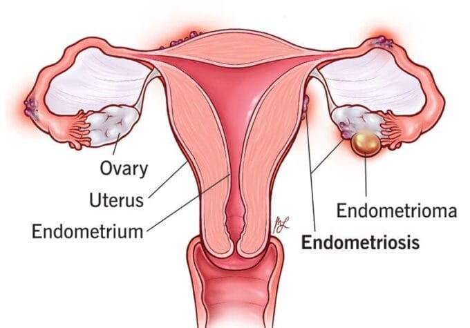 10857 endometriosis e1729445626810