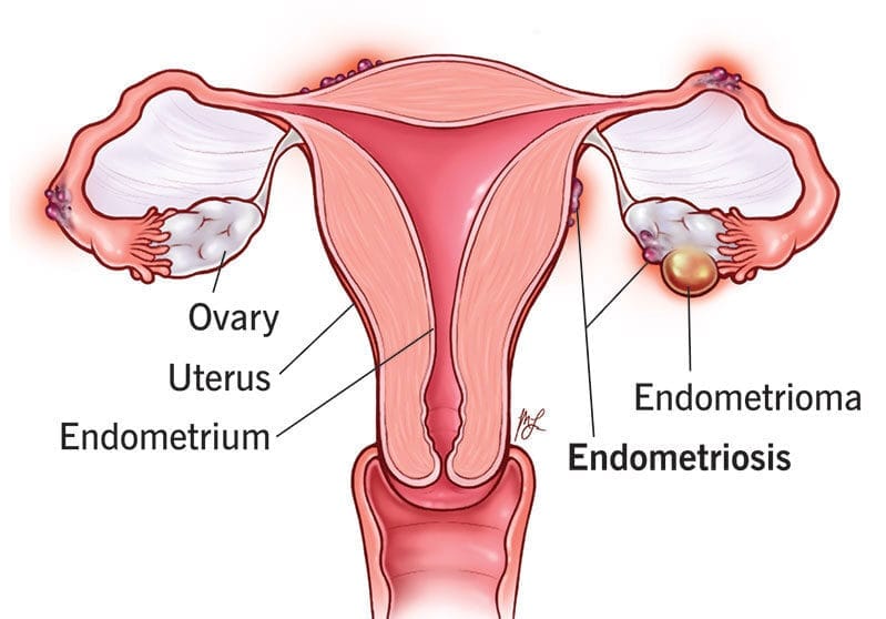 10857 endometriosis e1729445626810